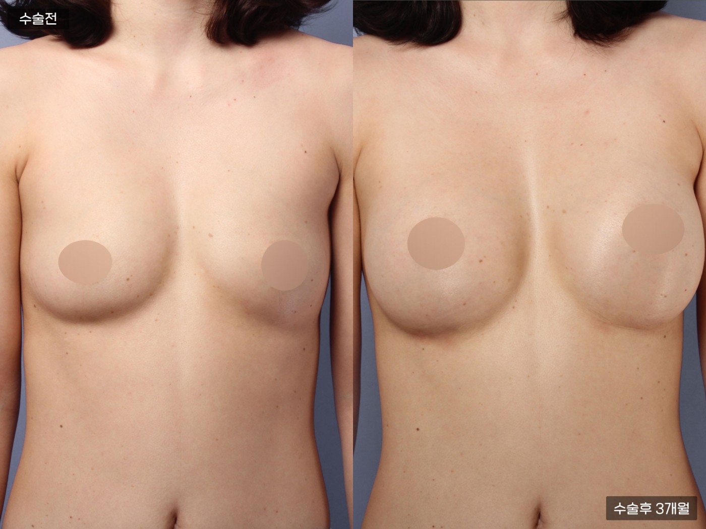 가슴성형 [가슴지방이식]