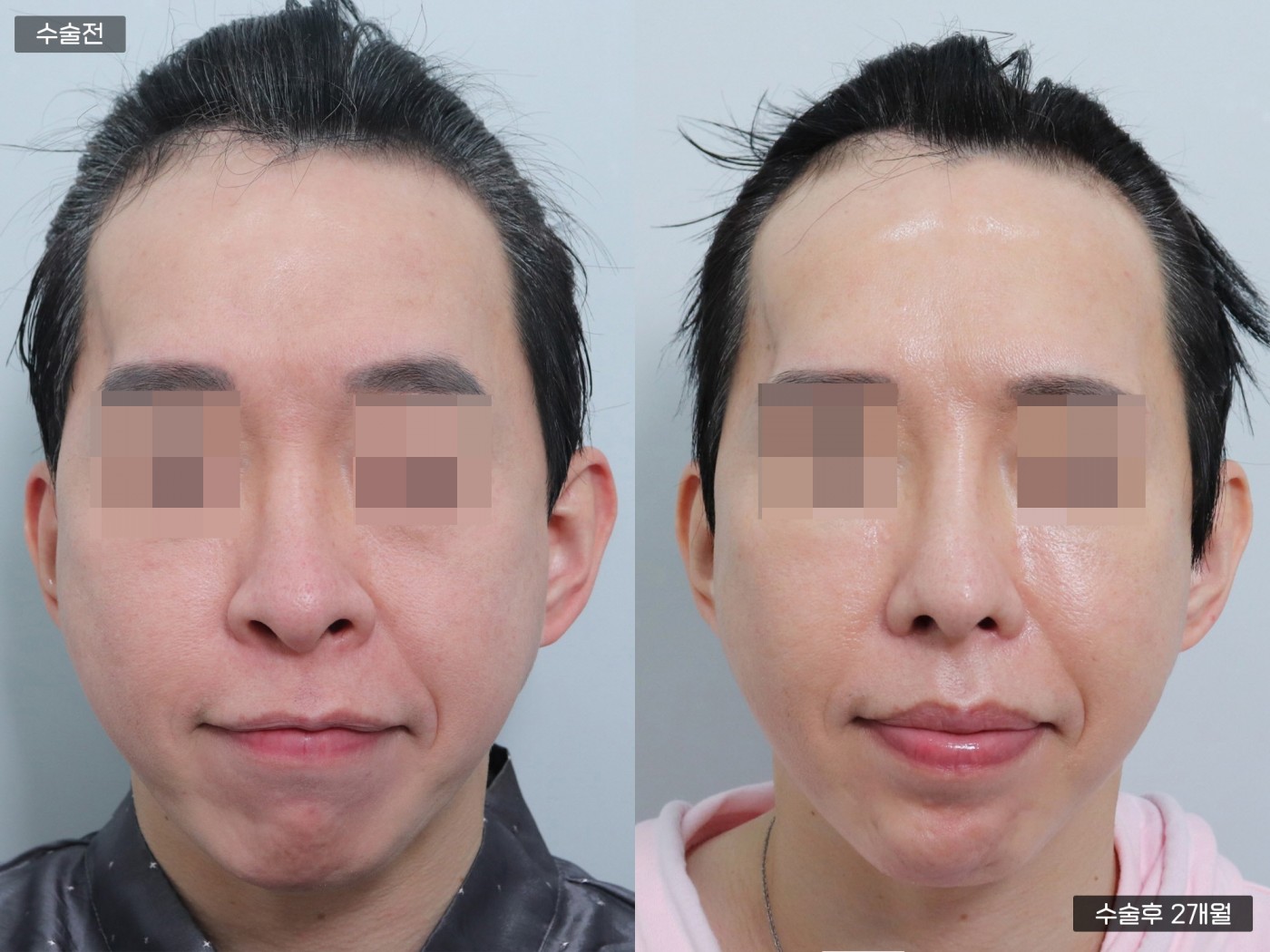 무턱교정 [턱보형물]