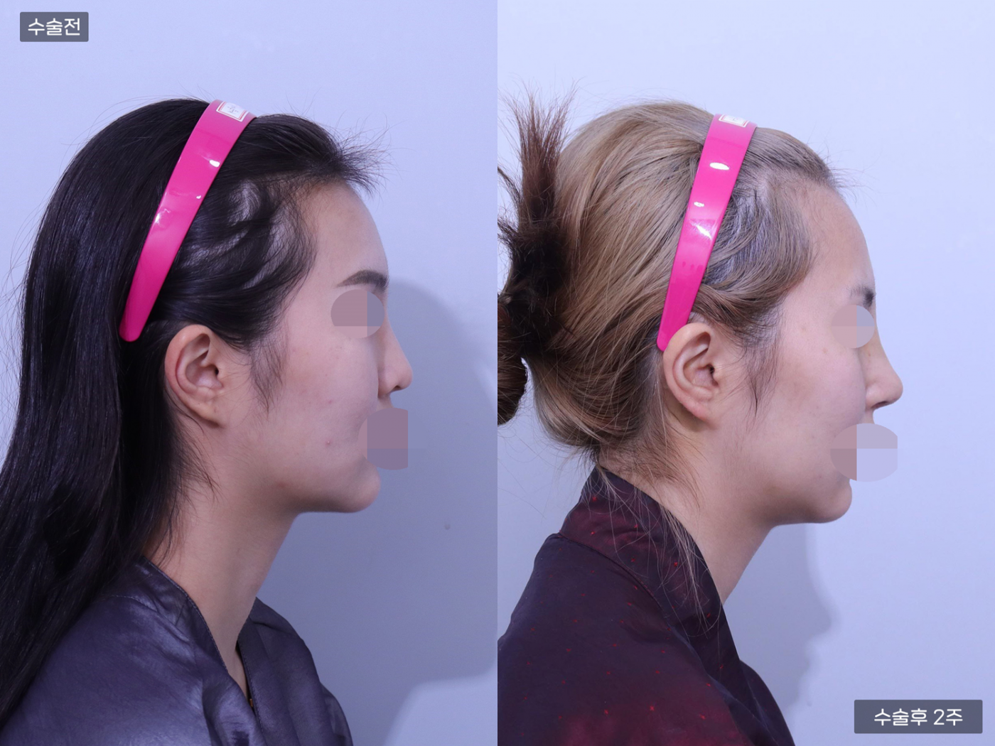 코끝(비중격) + 복코 + 매부리코