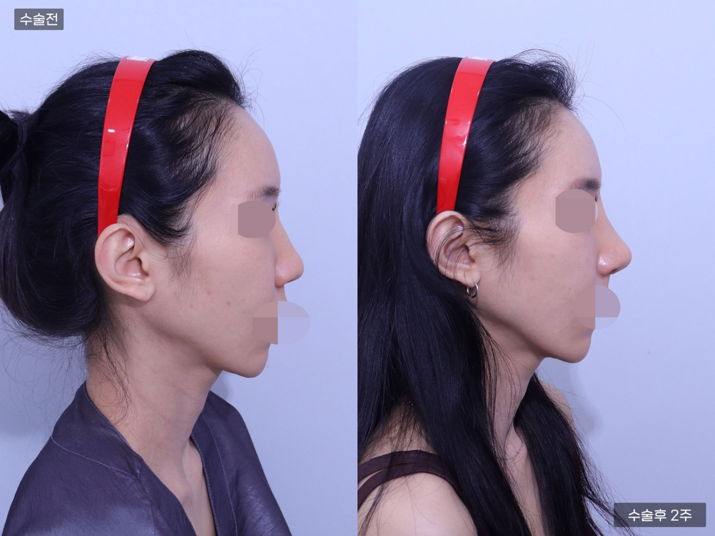 코끝 + 복코 + 매부리코