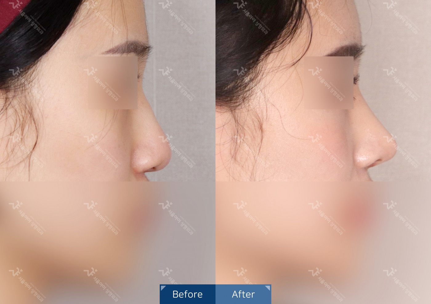 코성형 [코끝조각술+복코교정+매부리코교정]