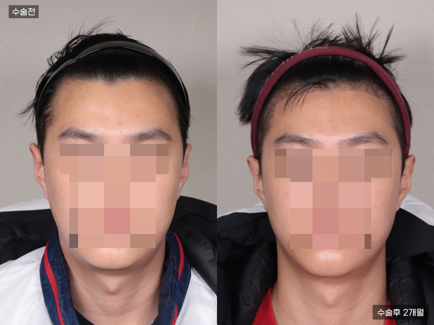 모발이식[비절개 모발이식(4000모)]