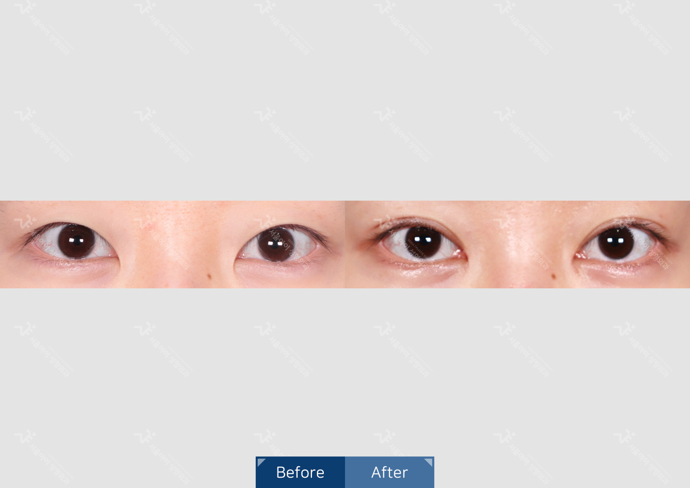 눈성형 [자연유착 쌍꺼풀]