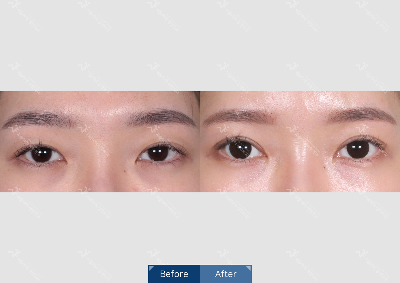 눈성형 [자연유착 쌍꺼풀]