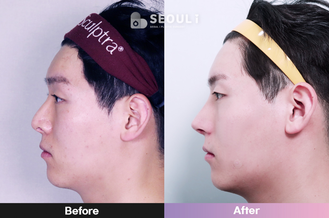 코끝(비중격) + 콧볼 축소술 + 복코 교정술 + 매부리 교정