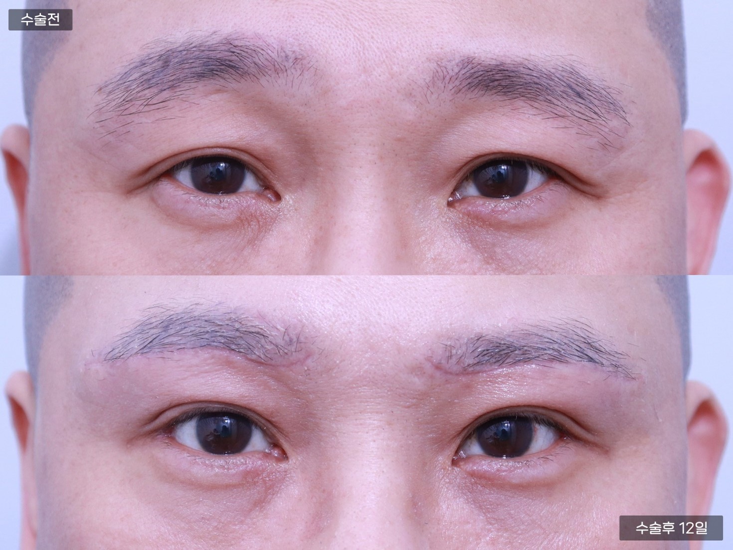 눈썹하거상술 + 뒤트임, 밑트임