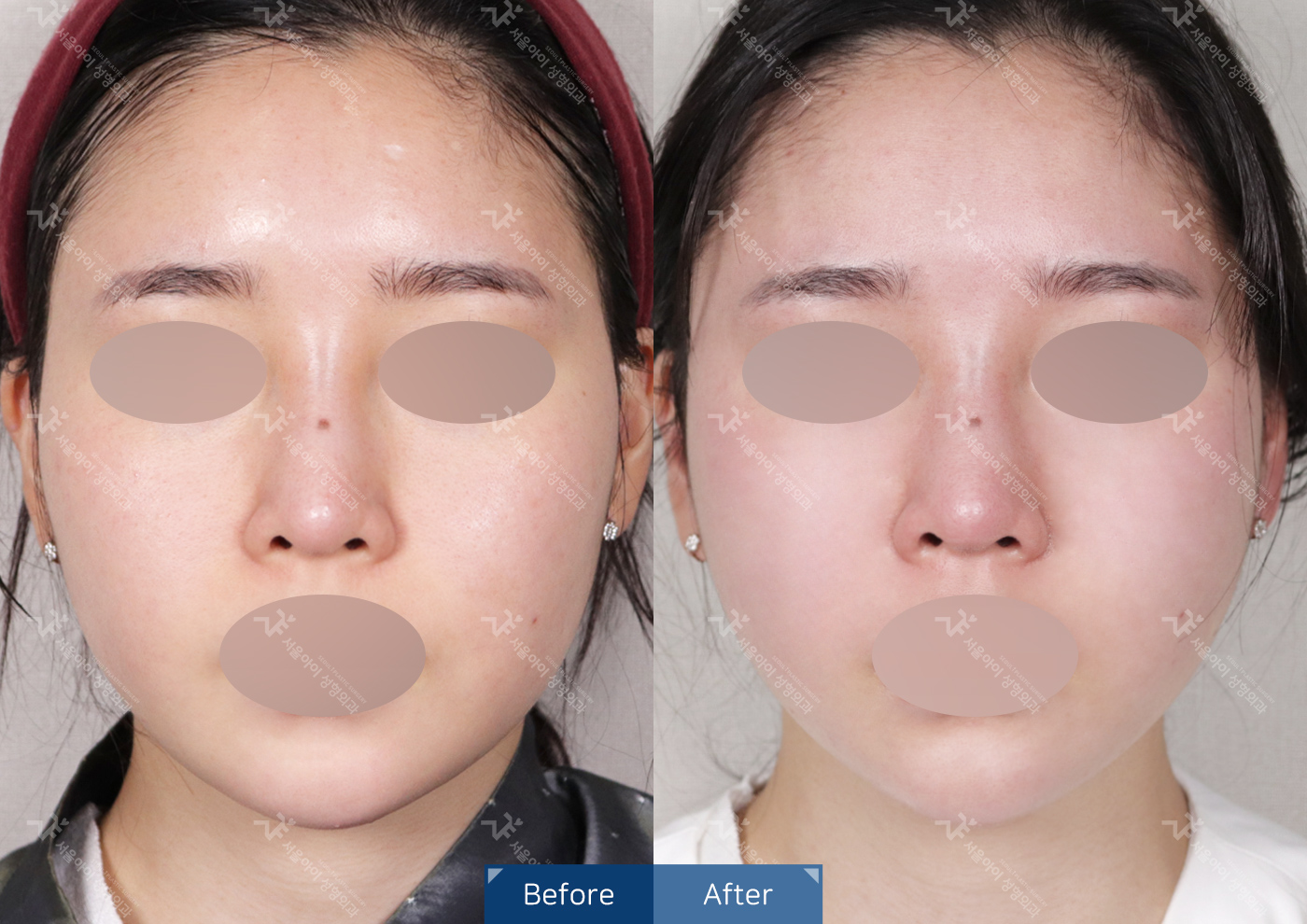 리프팅 [미니리프팅]