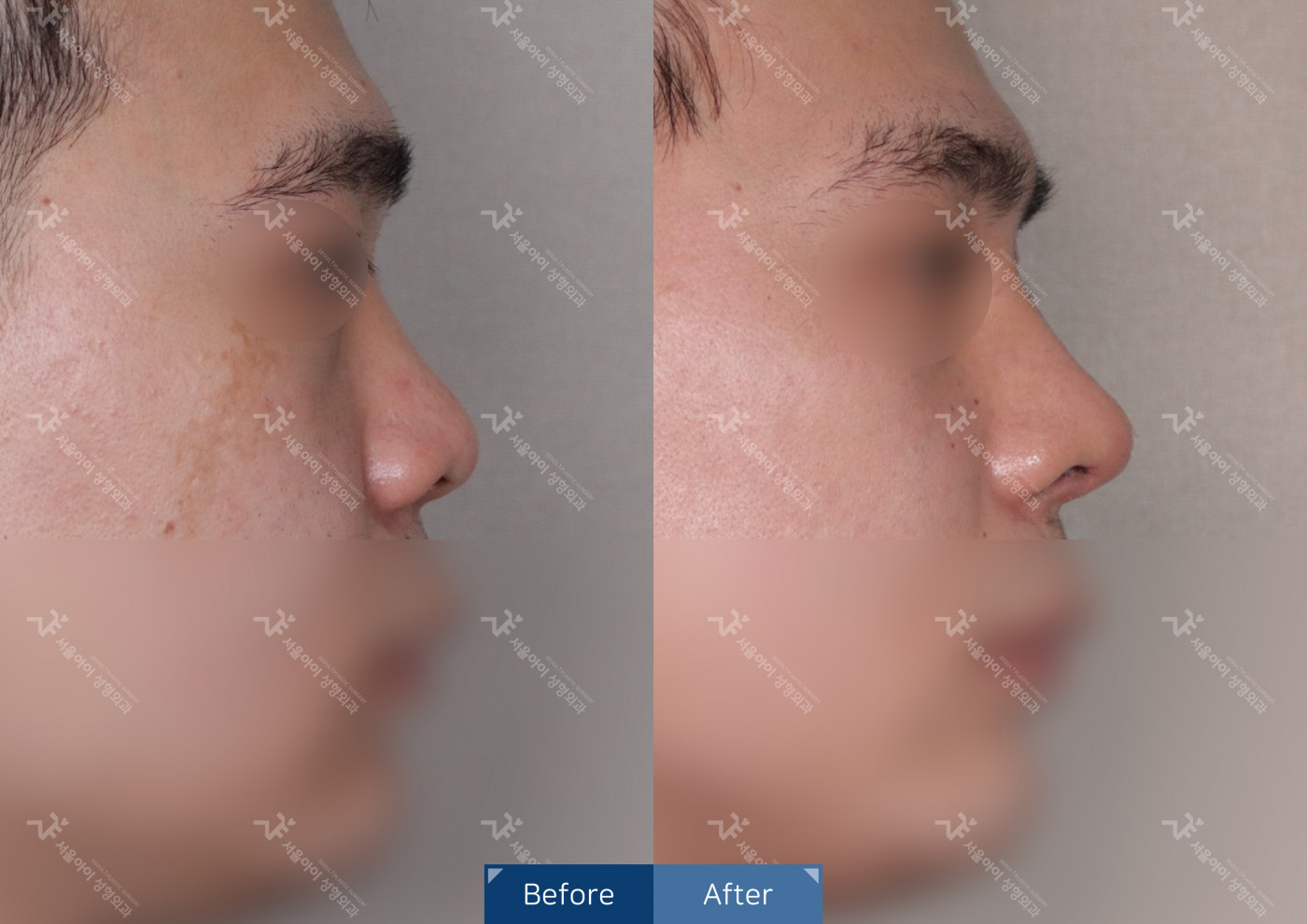 코성형 [코끝조각술+비중격+복코교정술+짧은 코 교정술]