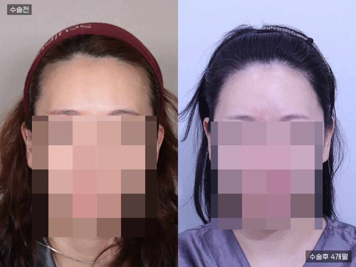 모발이식[절개 모발이식(3000모)]