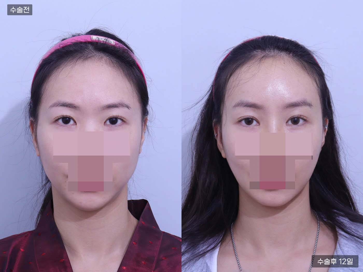 이중턱지흡 + 이마거상