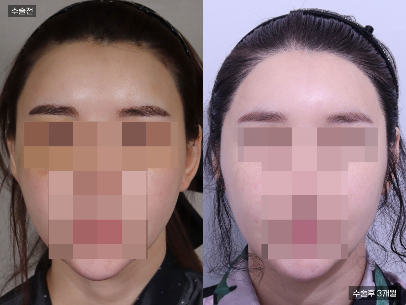 모발이식[비절개 모발이식(4000모)]