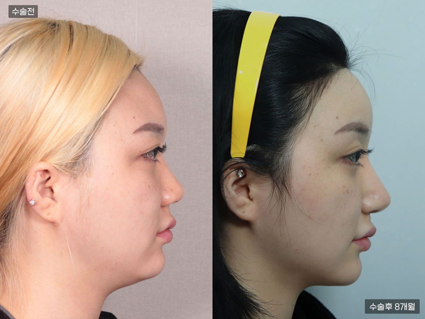 복코 + 매부리코 + 코끝(비중격)