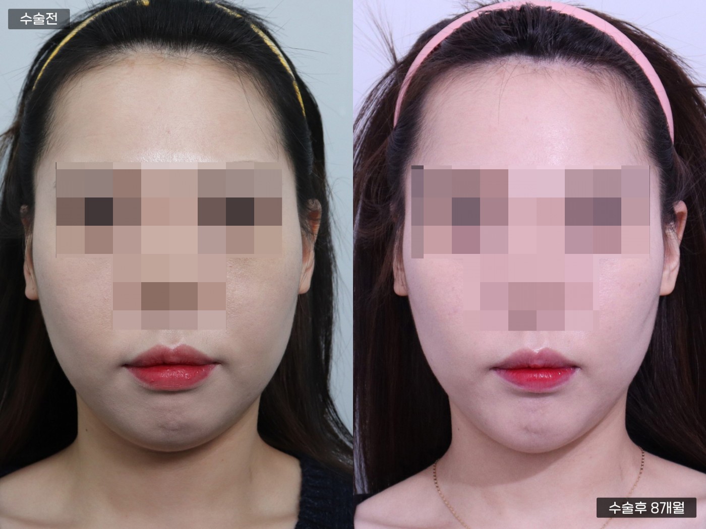 무턱교정 [턱끝 보형물]