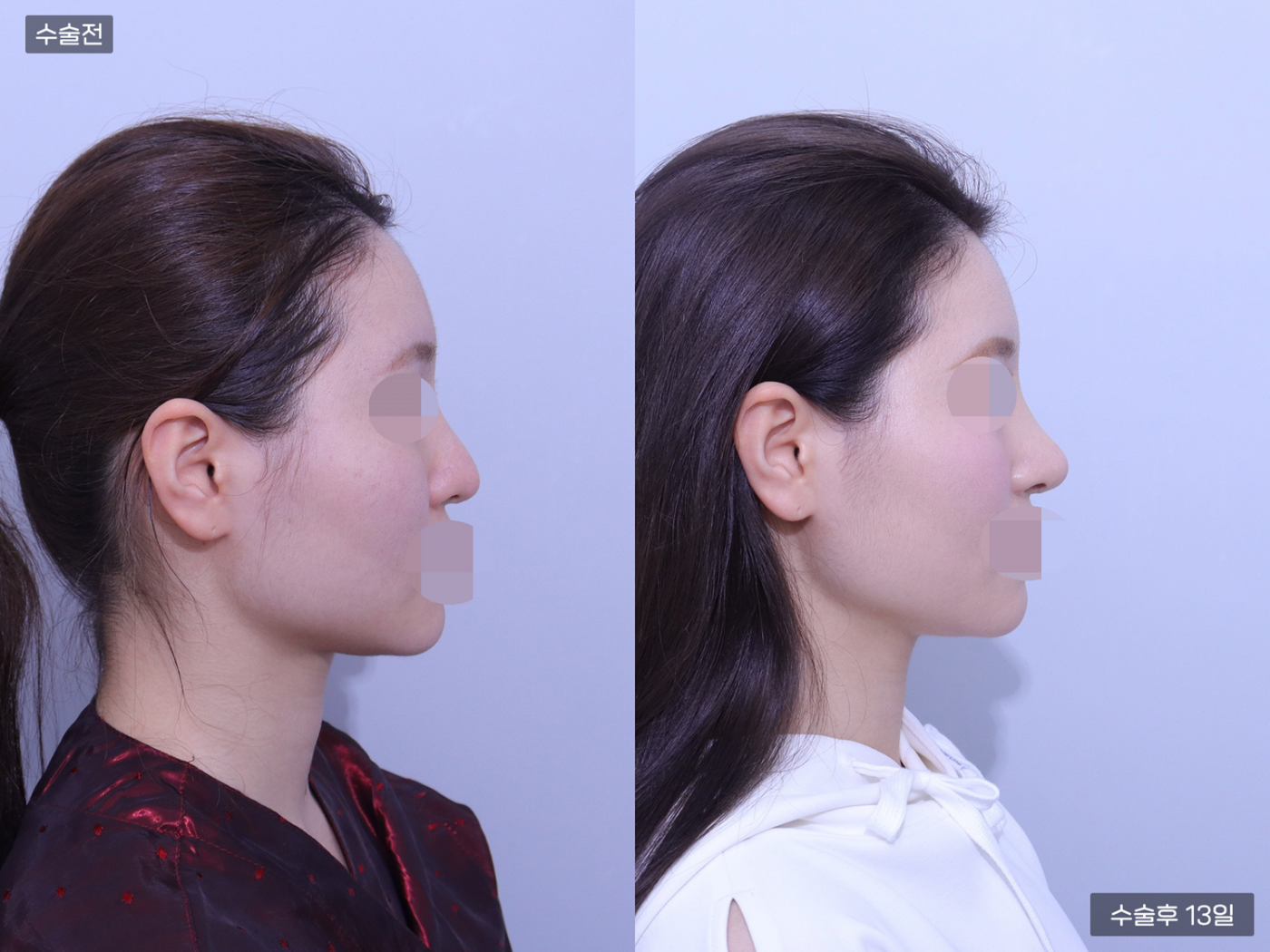 코재수술 + 코끝 + 복코 + 매부리코