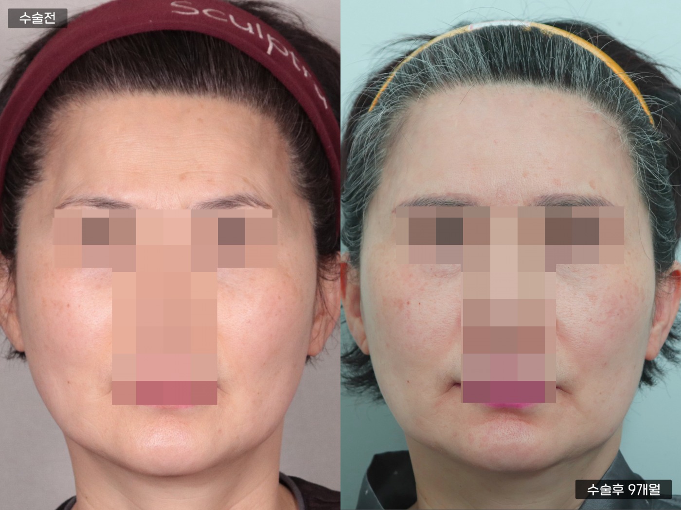 지방이식 [이마]