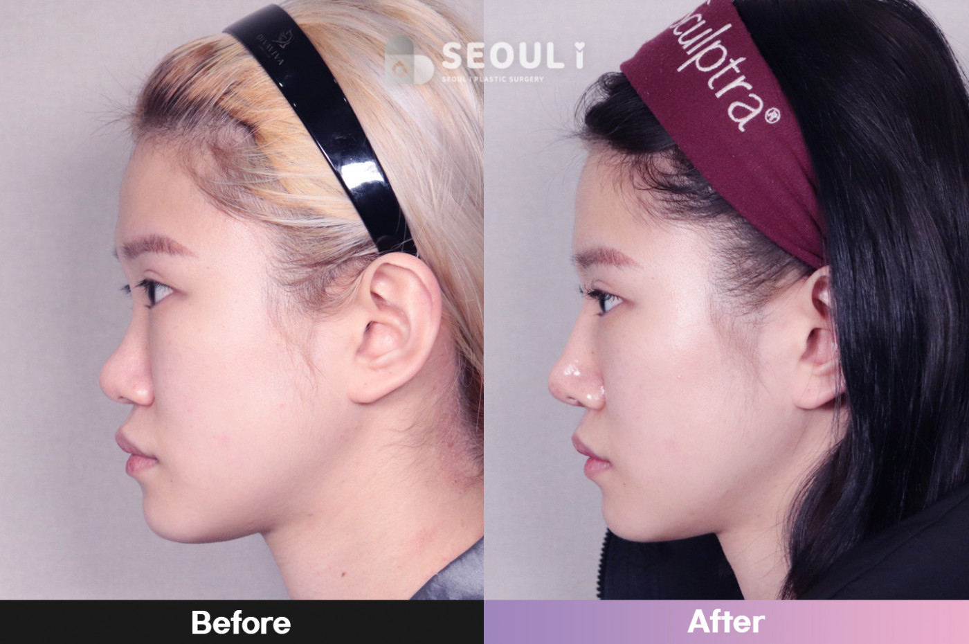 코끝(비중격) + 콧볼 축소술 + 매부리 교정