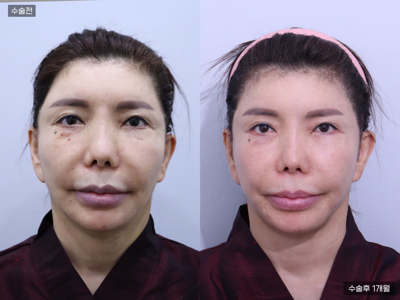 모발이식 [절개 모발이식(4000모)]