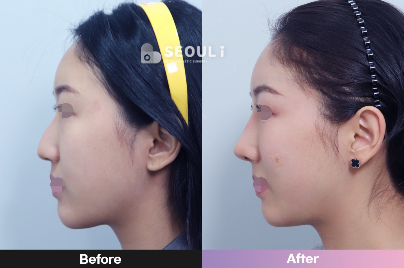 코끝(비중격) + 콧볼 축소술 + 매부리 교정