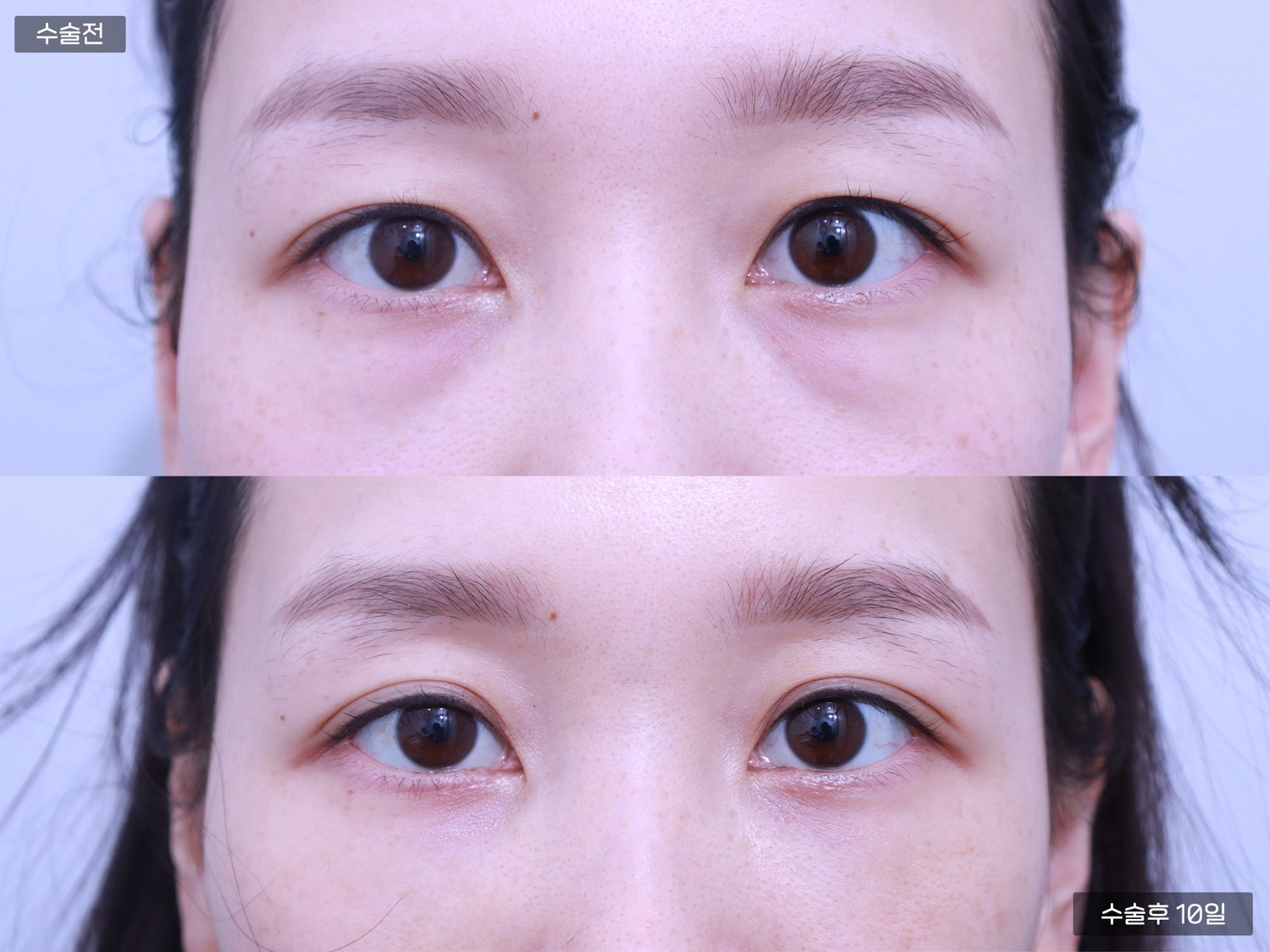 눈밑지방재배치