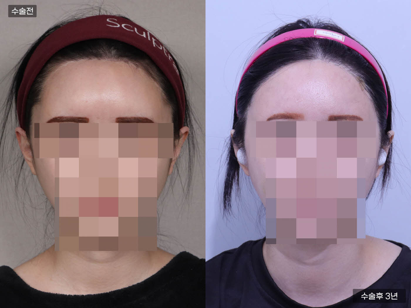 모발이식[비절개 모발이식(4500모)]