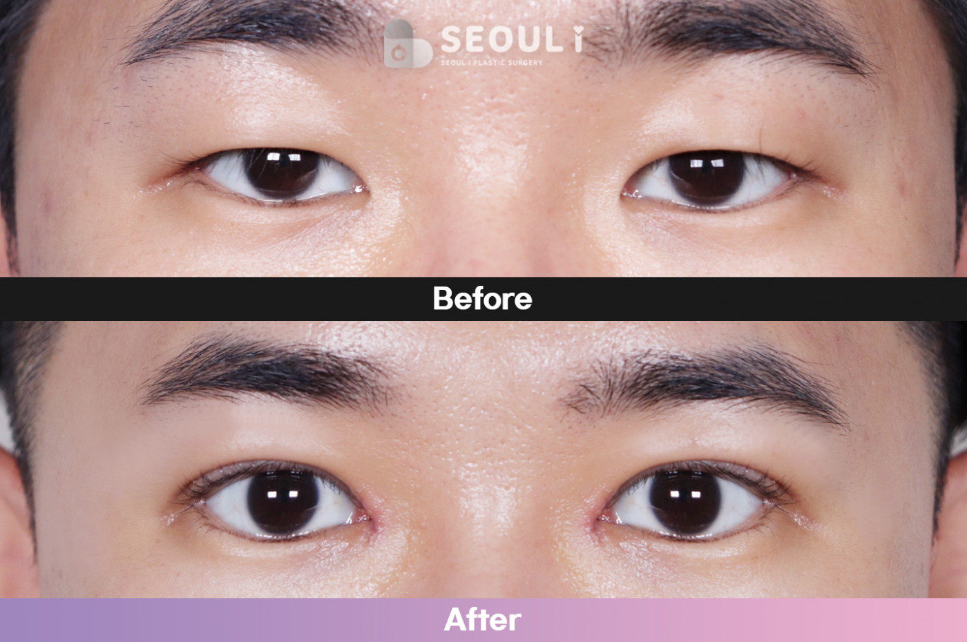 눈성형 [자연유착 쌍꺼풀 + 앞트임 + 눈매교정]