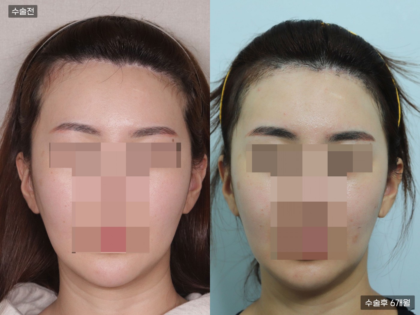 모발이식 [비절개 모발이식(4000모)]