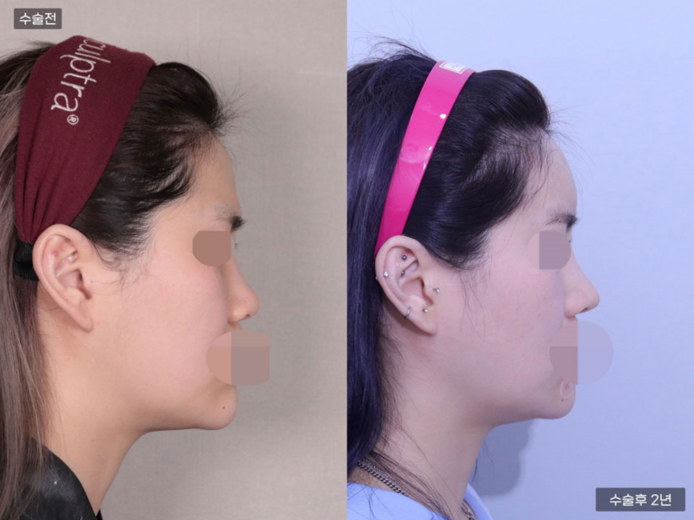 복코 + 코끝 + 콧볼축소 + 매부리코