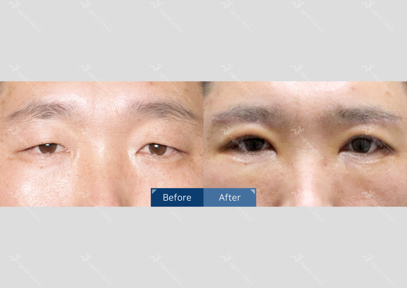 눈성형 [눈썹하거상술 + 자연유착 + 안검하수]