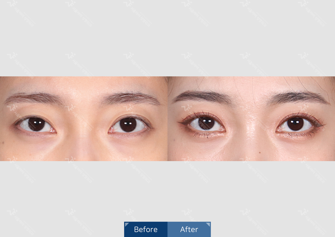 눈성형 [자연유착 쌍꺼풀]