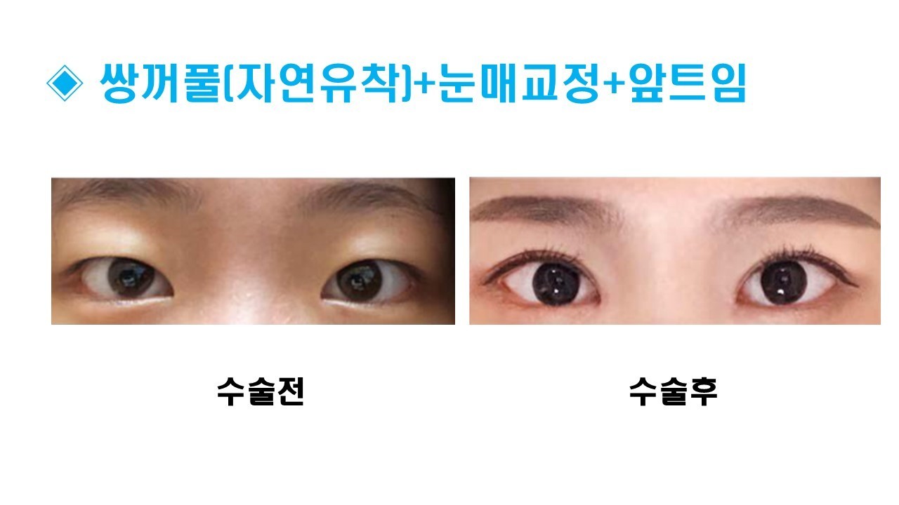 눈성형 [자연유착 쌍꺼풀 + 눈매교정 + 앞트임]