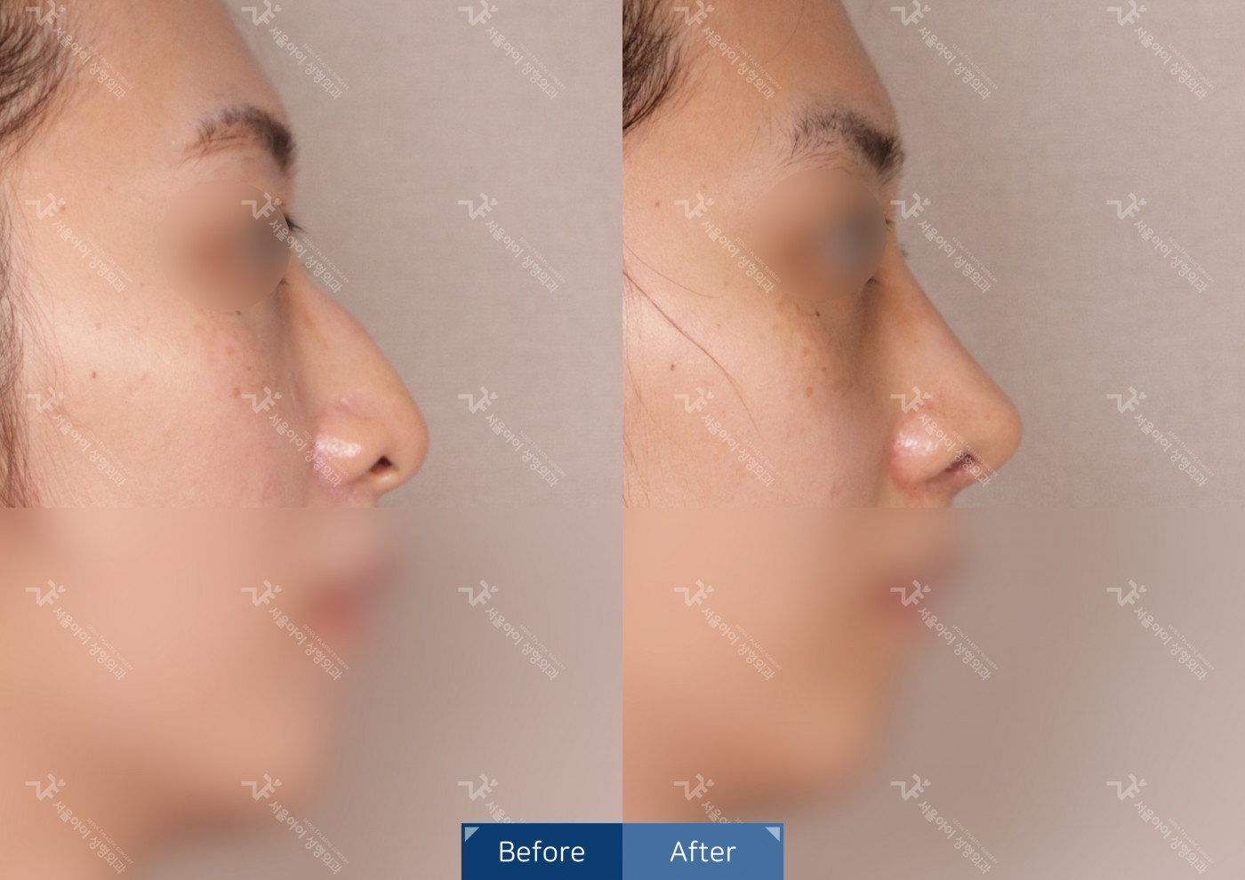 코성형[코끝조각술+비중격+복코교정술]