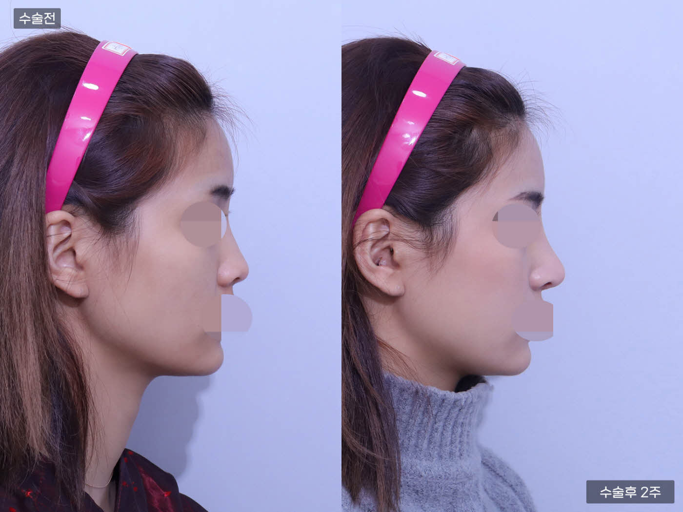 코끝(비중격) + 복코 + 콧볼축소