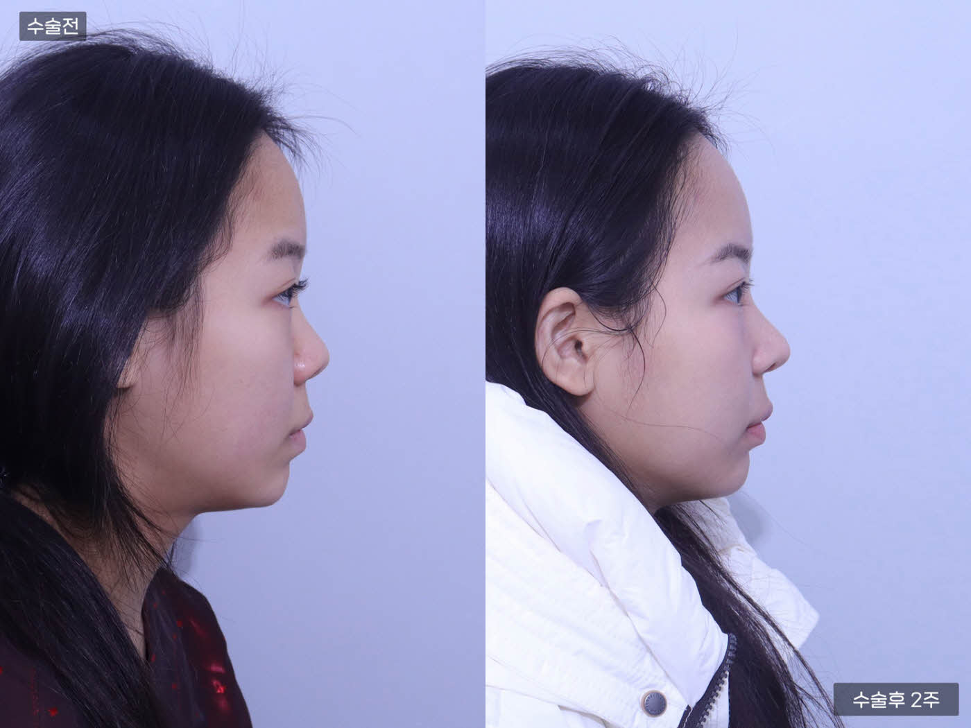 코끝교정 + 매부리코 +콧볼축소