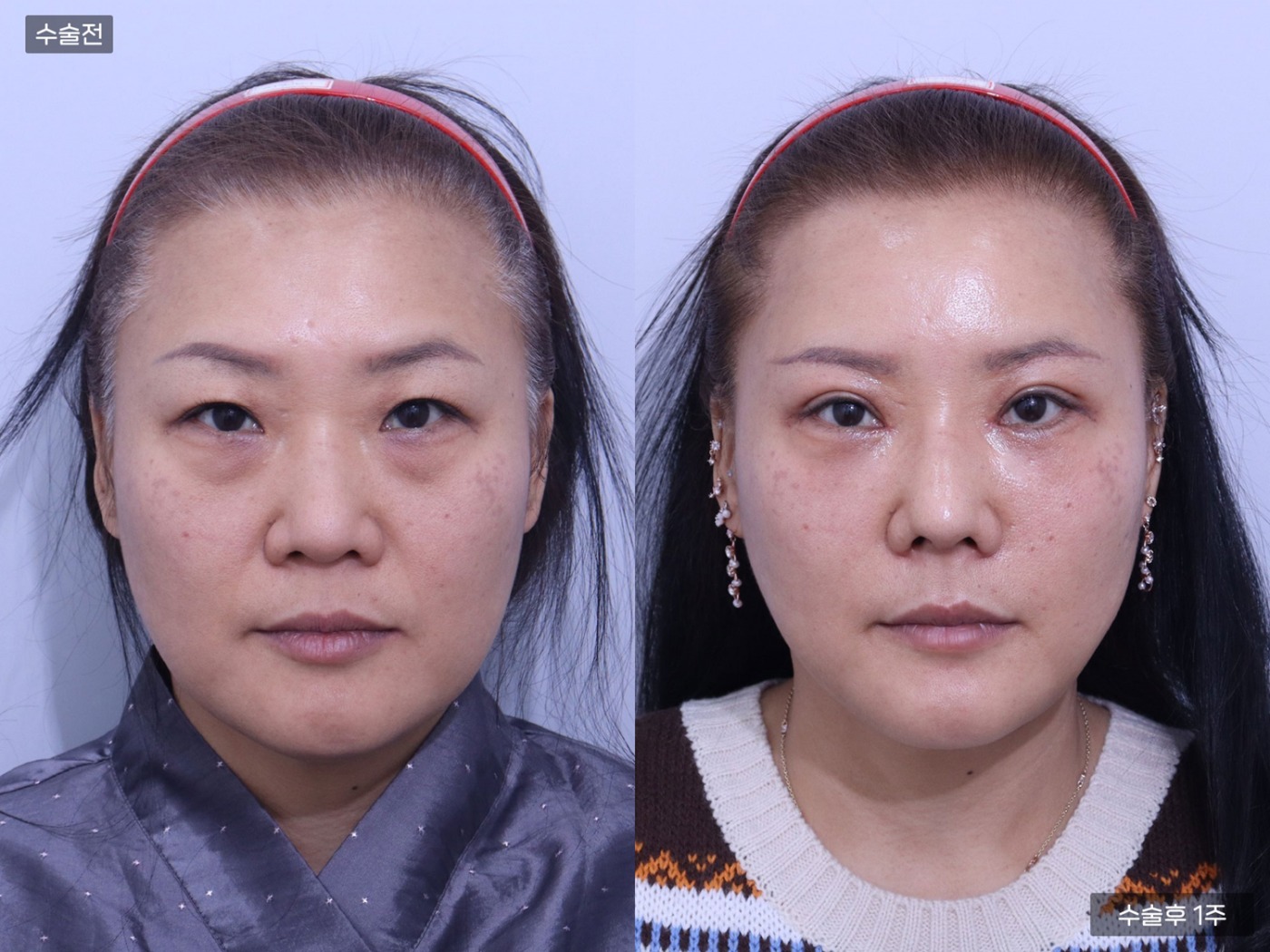 지방이식 [풀페이스]