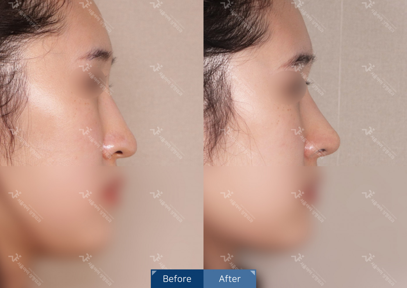 코성형[코끝조각술+비중격+복코교정술]
