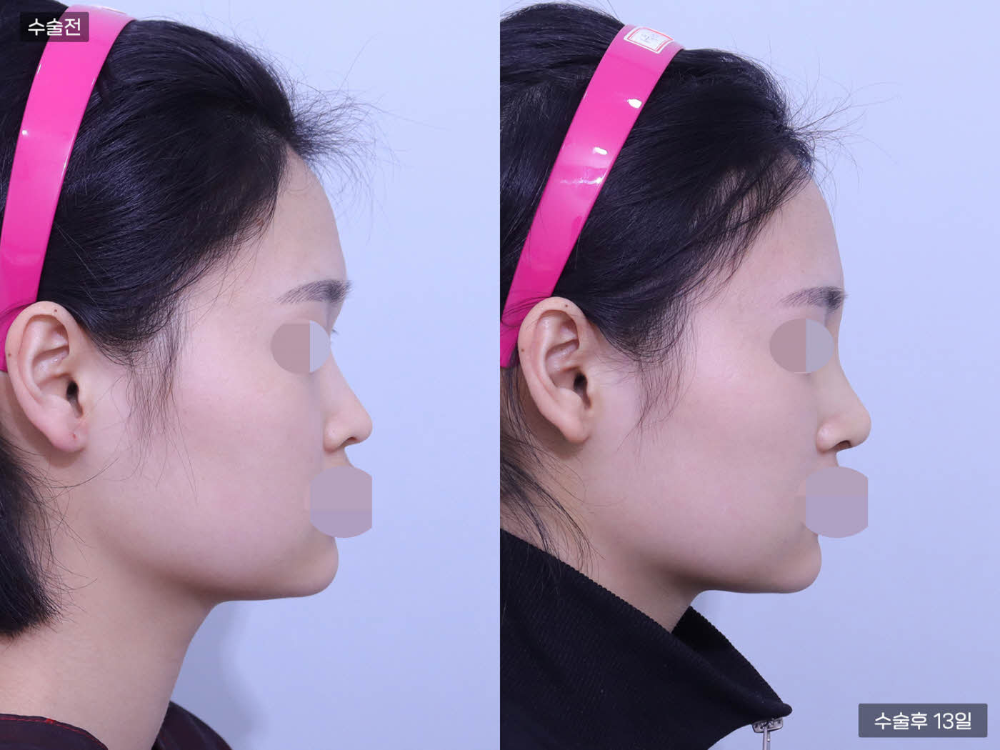 코끝(비중격) + 복코 + 매부리코