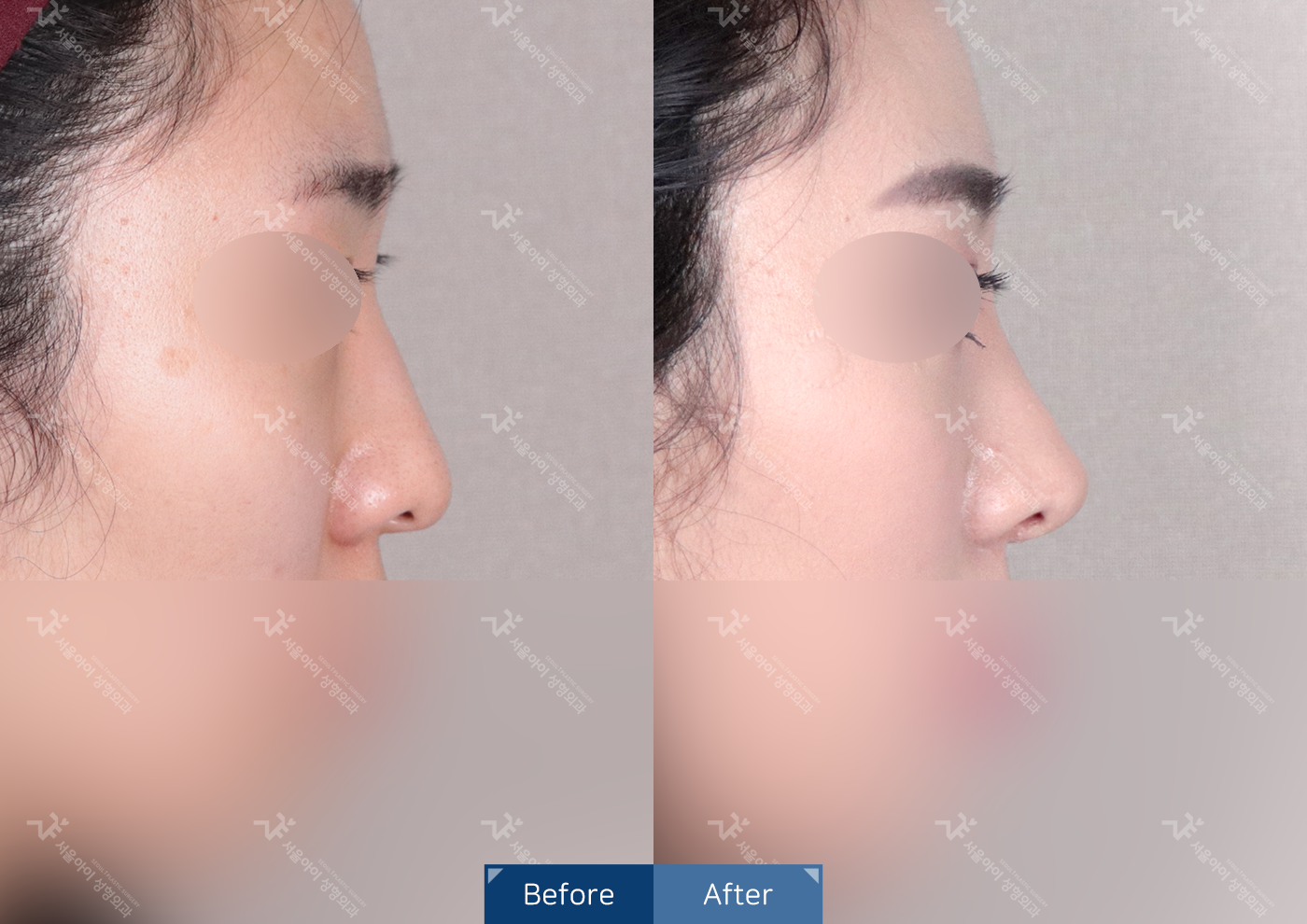 코성형[미용코]