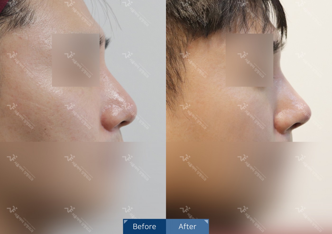 코성형 [코끝조각술+비중격+복코교정술]