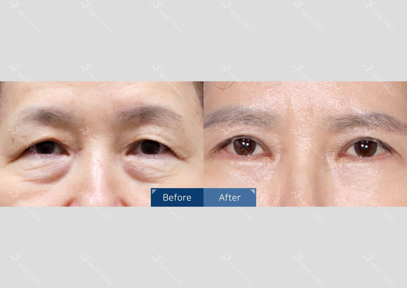 눈성형 [눈썹하거상술 + 하안검]