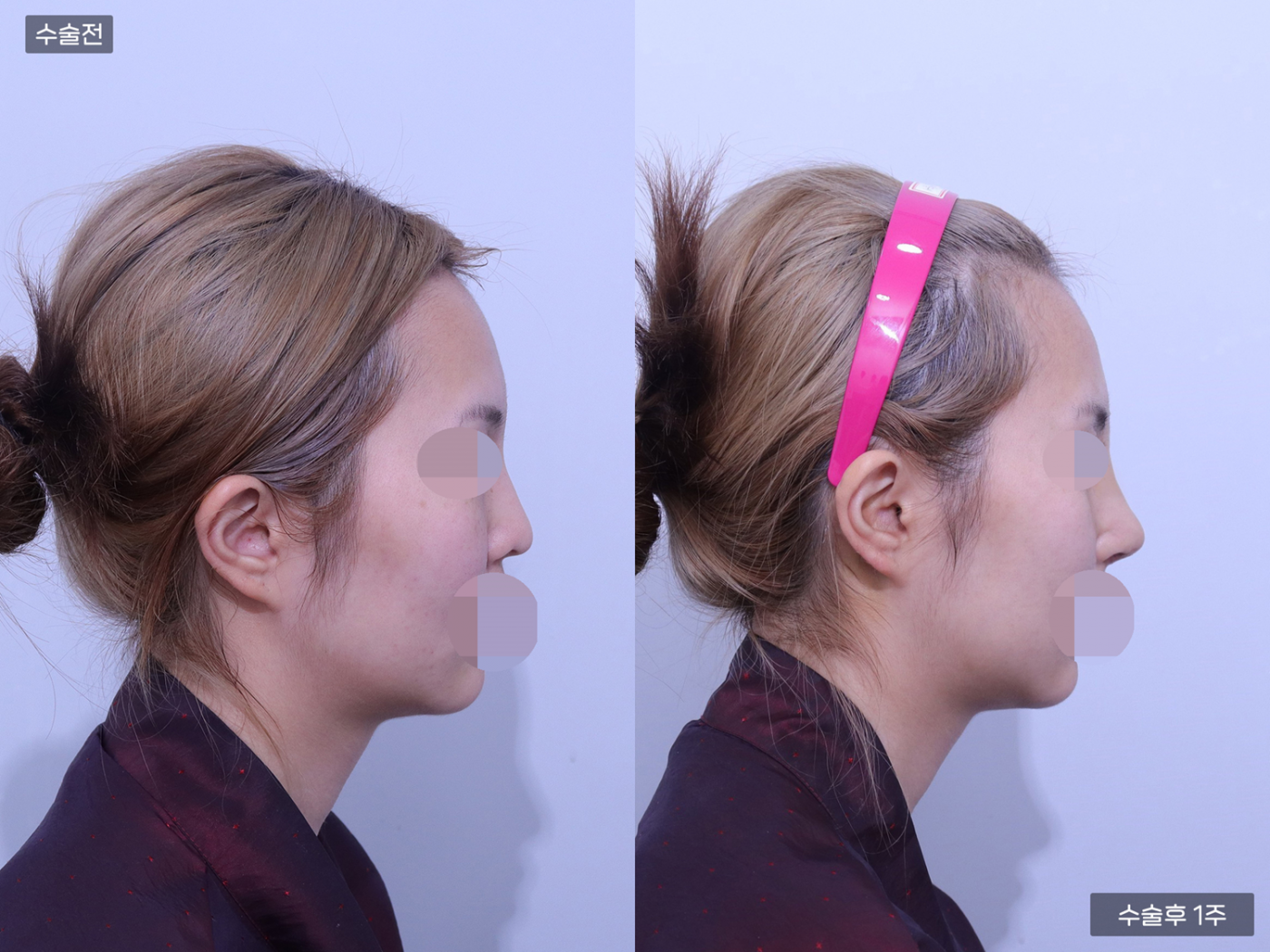 코끝(비중격) + 복코 + 매부리코