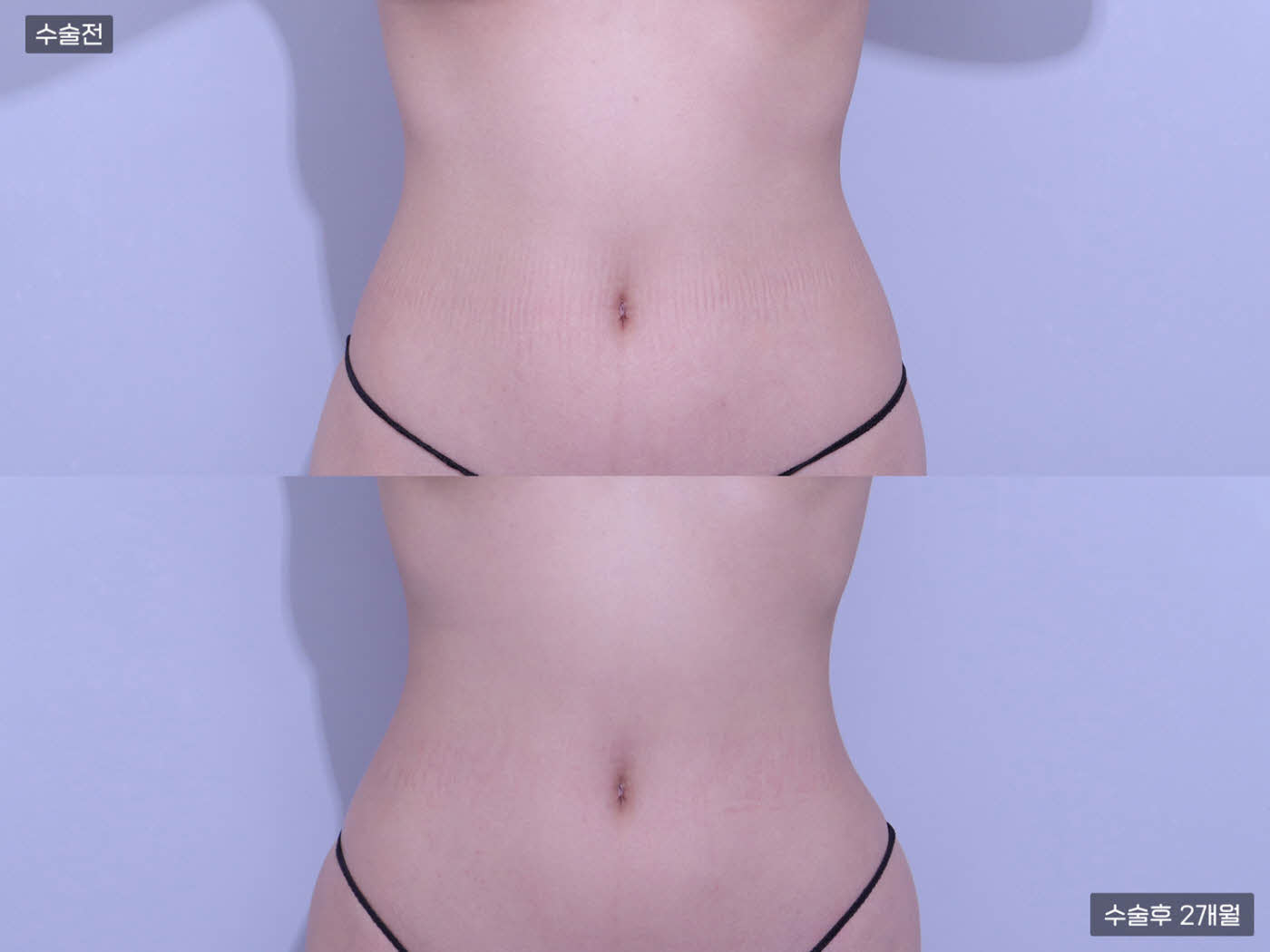 복부 지방흡입