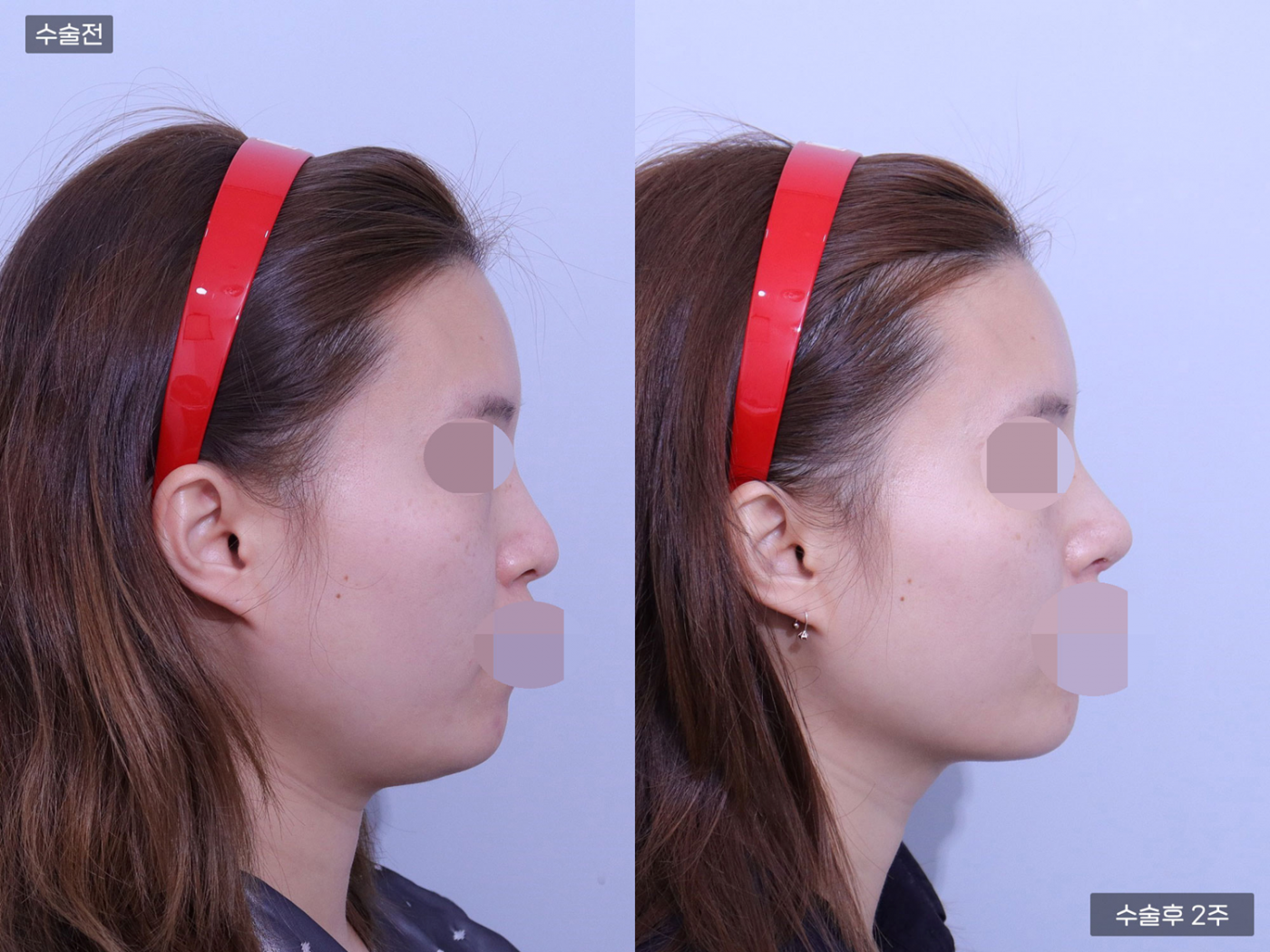 코끝 + 매부리코 + 복코