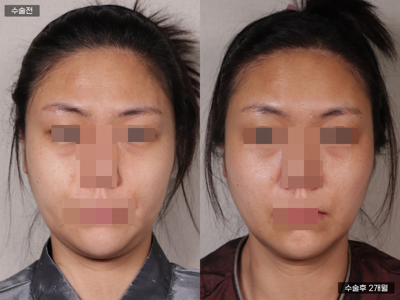 지방이식 [이마]