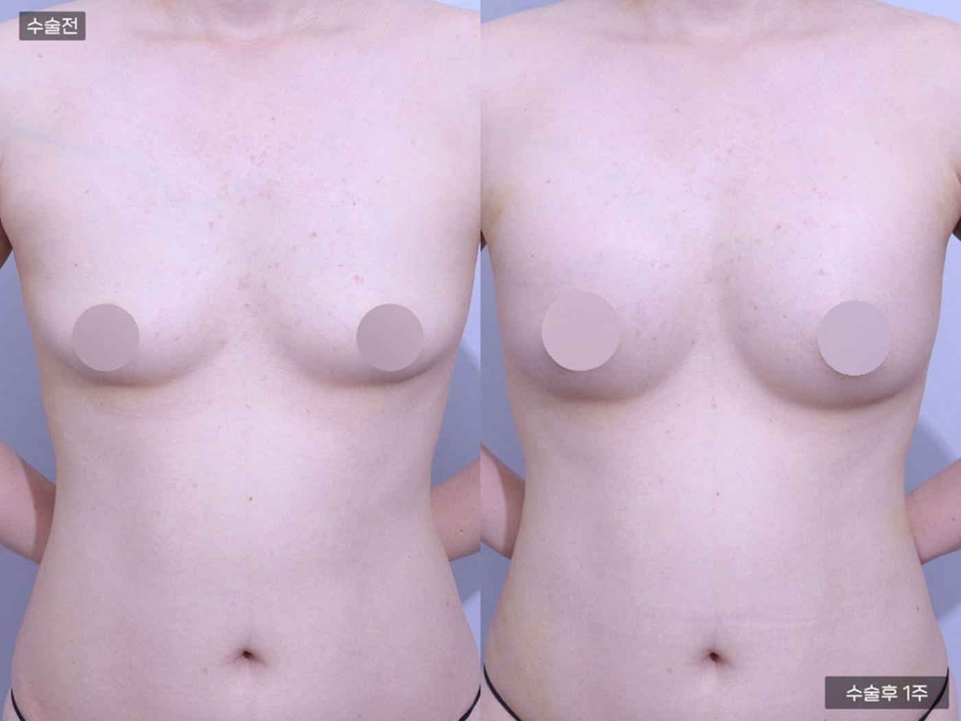 가슴성형 [가슴지방이식(150CC + 150CC)]