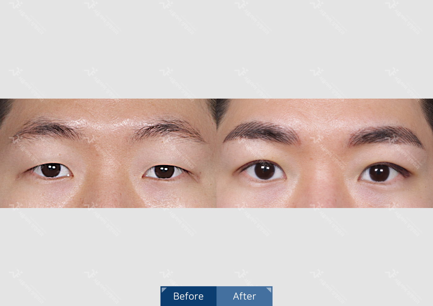 눈성형 [자연유착 쌍꺼풀]