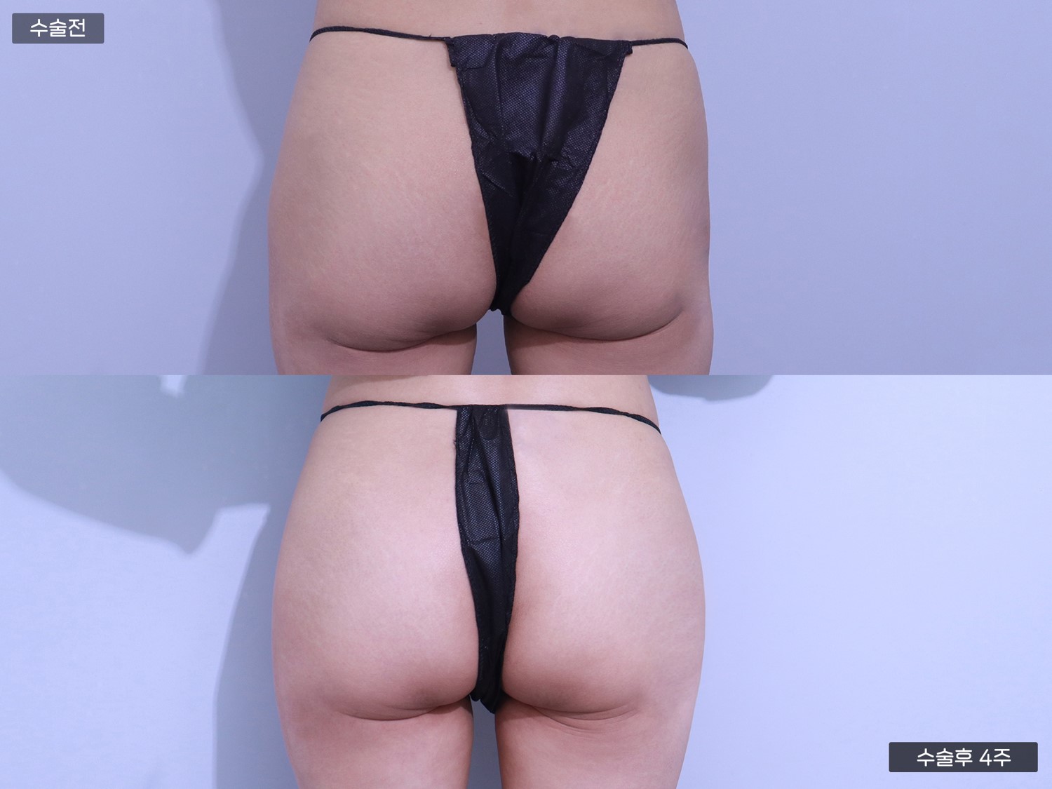 PRP 힙 지방이식 (100cc + 100cc)