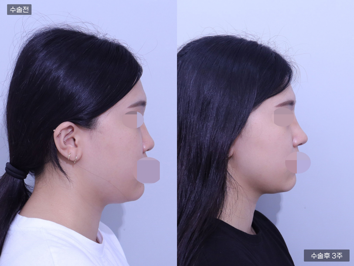 코끝 + 복코교정 + 매부리코