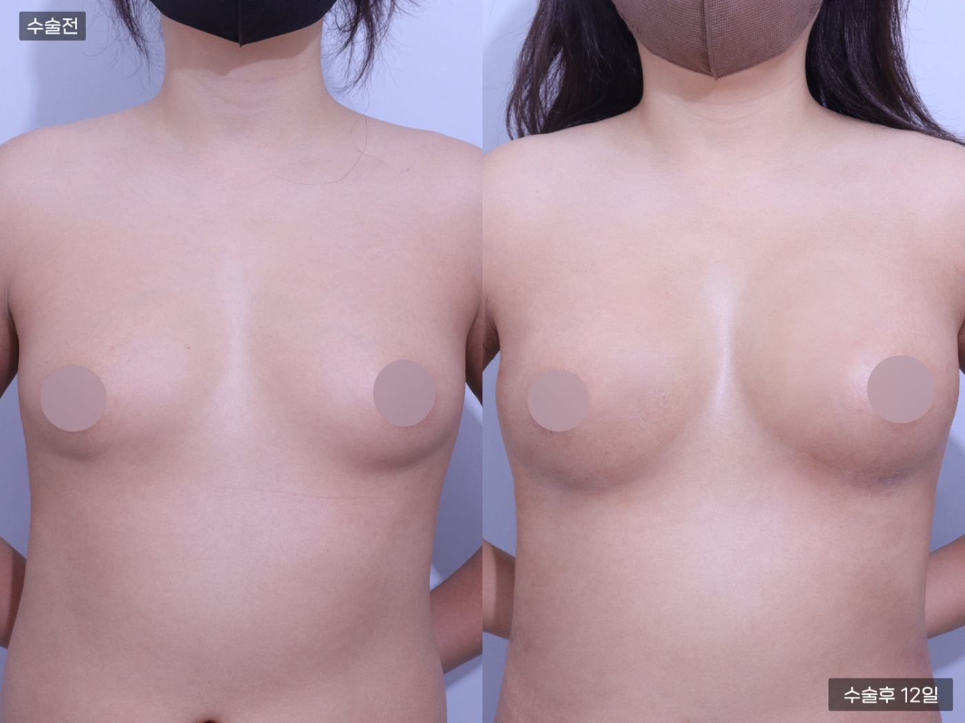 가슴성형 [가슴지방이식(300CC + 300CC)]