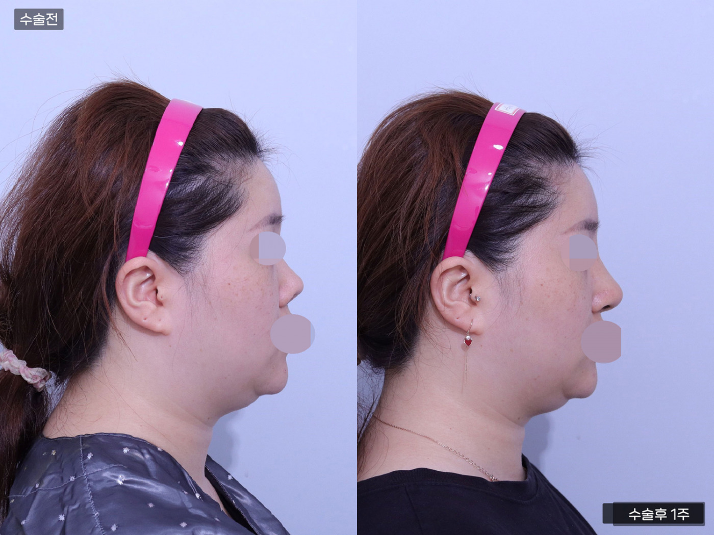 코재수술 + 코끝