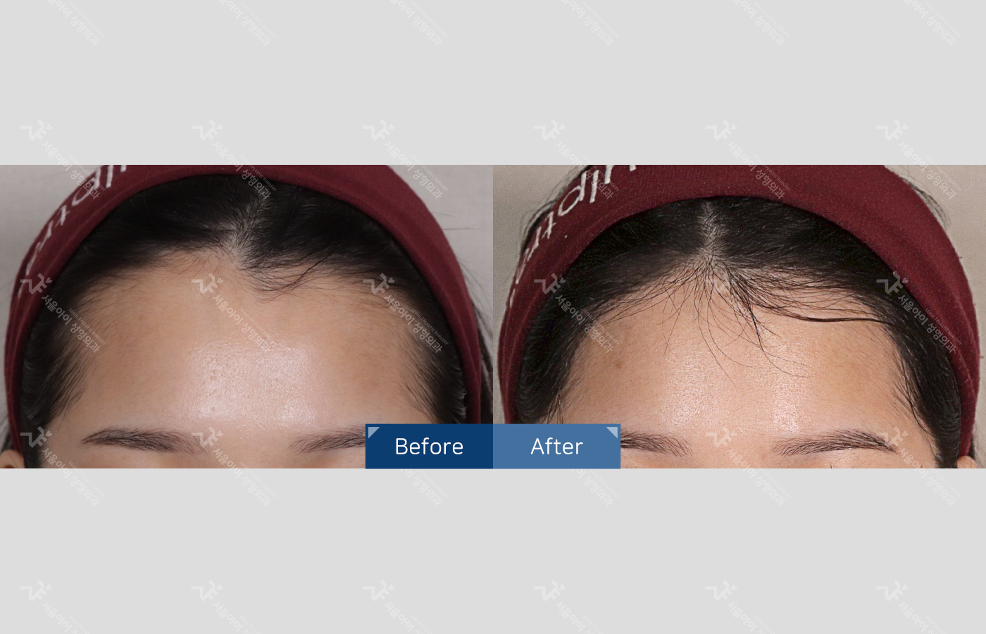 모발이식 [절개 모발이식(3000모) + 헤어라인 + 엠자]